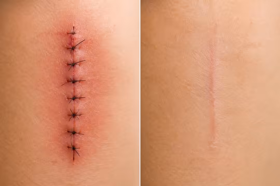 découvrez le processus de cicatrisation des points de suture avec des images avant et après, et comprenez à quoi vous attendre lors de la guérison.