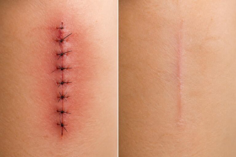 découvrez le processus de cicatrisation des points de suture avec des images avant et après, et comprenez à quoi vous attendre lors de la guérison.