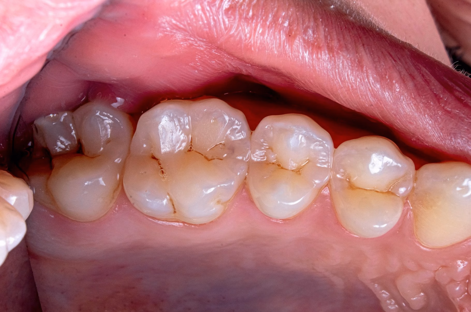 Infection sous couronne dentaire : symptômes d&rsquo;alerte
