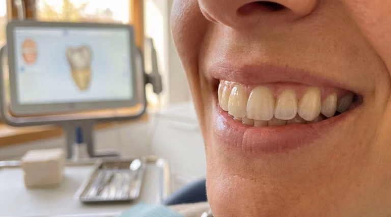 Remplacer une dent sans implant : alternatives efficaces